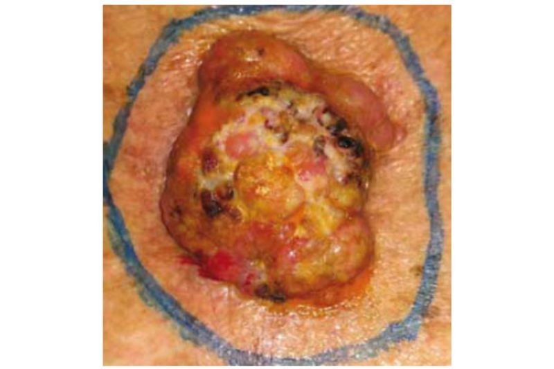 Sintomas e Aspectos Clínicos